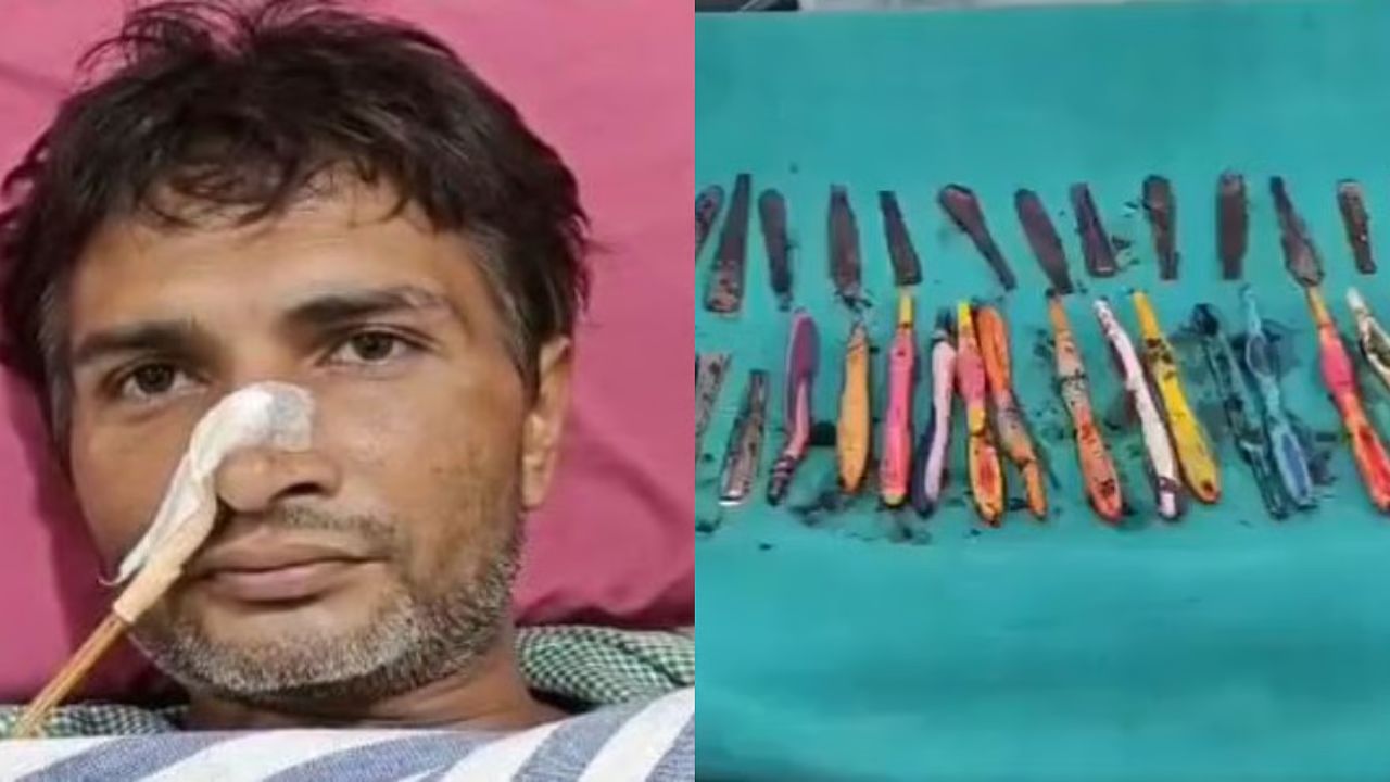 29 ஸ்பூன்கள், 19 டூத் பிரஷ்களை விழுங்கிய இளைஞர்.. அறுவை சிகிச்சை மூலம் அகற்றம்!